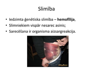 Slimība
• Iedzimta ģenētiska slimība – hemofīlija,
• Slimniekiem vispār nesarec asinis;
• Sarecēšana ir organisma aizsargreakcija.
 