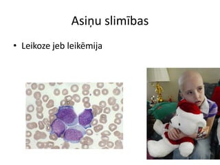 Asiņu slimības
• Leikoze jeb leikēmija
 