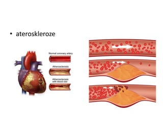 • ateroskleroze
 