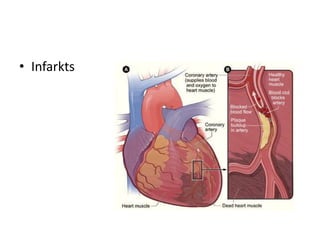 • Infarkts
 