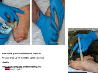 17
Ieber brūcē granulas vai tamponē to ar saiti
Nospiež brūci uz 3-5 minūtēm, uzliek spiedošo
pārsēju
Pie pārsēja piestiprina izlietotu iepakojumu
 