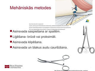22
 Asinsvada saspiešana ar spailēm.
 Liģēšana- brūcē vai proksimāli.
 Asinsvada klipēšana.
 Asinsvada un blakus audu cauršūšana.
Mehāniskās metodes
https://www2.aofoundation.org/wps/portal/!
ut/p/a0/04_Sj9CPykssy0xPLMnMz0vMAfGjzOKN_A0M3D2DDbz9_UMMDRyDXQ3dw9wMDAwCTfULsh0VAXc5ElM!/?
approach=Lateral%20approach&bone=Femur&classification=32-A3&contentUrl=%2Fsrg%2F32%2F04-Approaches%2F32-
A20_lat_appr.jsp&implantstype=&method=&redfix_url=&segment=Shaft&showPage=approach&treatment=
 