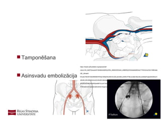 24
 Tamponēšana
 Asinsvadu embolizācija
https://www2.aofoundation.org/wps/portal/!
ut/p/a1/04_Sj9CPykssy0xPLMnMz0vMAfGjzOKN_A0M3D2DDbz9_UMMDRyDXQ3dw9wMDAwCTYEKIvEocDQnTr8BDuBo
QEi_l35Uek5-
EtCp4U76UWYZblGR6SBDHfOSjC3S9aOKUtNSi1KL9DLyi0v0I8rLy430EvPT8kvzUsBe1MsvStcvyA2NqPIsdgQAlGS0nw!!/
dl5/d5/L0lDU0lKSWdrbUEhIS9JRFJBQUlpQ2dBek15cXchLzRKQ2hEb01kdEJnY2huQVZHRUEhL1o3XzJPMDBHSVMwS0
9PVDEwQVNFMUdWRjAwMDYzLzA!/?showPage=redfix&bone=Pelvis&segment=Ring&classification=61-
AT&treatment=operative&method=Angio+embolization&implantstype=
 