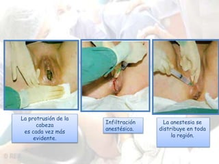 La anestesia se 
distribuye en toda 
la región. 
La protrusión de la 
cabeza 
es cada vez más 
evidente. 
Infiltración 
anestésica. 
 