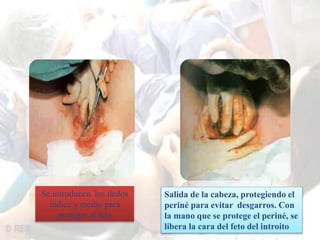 Se introducen los dedos 
índice y medio para 
proteger al feto 
Salida de la cabeza, protegiendo el 
periné para evitar desgarros. Con 
la mano que se protege el periné, se 
libera la cara del feto del introito 
 