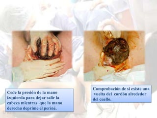 Cede la presión de la mano 
izquierda para dejar salir la 
cabeza mientras que la mano 
derecha deprime el periné. 
Comprobación de si existe una 
vuelta del cordón alrededor 
del cuello. 
 