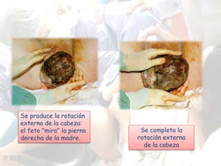 Se produce la rotación 
externa de la cabeza: 
el feto "mira" la pierna 
derecha de la madre. 
Se completa la 
rotación externa 
de la cabeza 
 