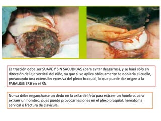 La tracción debe ser SUAVE Y SIN SACUDIDAS (para evitar desgarros), y se hará sólo en 
dirección del eje vertical del niño, ya que si se aplica oblicuamente se doblaría el cuello, 
provocando una extensión excesiva del plexo braquial, lo que puede dar origen a la 
PARALISIS ERB en el RN. 
Nunca debe engancharse un dedo en la axila del feto para extraer un hombro, para 
extraer un hombro, pues puede provocar lesiones en el plexo braquial, hematoma 
cervical o fractura de clavícula. 
 