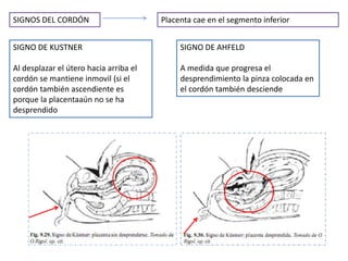 SIGNOS DEL CORDÓN Placenta cae en el segmento inferior 
SIGNO DE KUSTNER 
Al desplazar el útero hacia arriba el 
cordón se mantiene inmovil (si el 
cordón también ascendiente es 
porque la placentaaún no se ha 
desprendido 
SIGNO DE AHFELD 
A medida que progresa el 
desprendimiento la pinza colocada en 
el cordón también desciende 
 