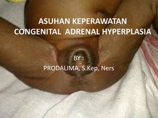 ASUHAN KEPERAWATAN
CONGENITAL ADRENAL HYPERPLASIA

              BY :
      PRODALIMA, S.Kep, Ners
 