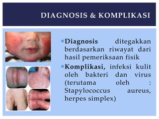 Diagnosis ditegakkan
berdasarkan riwayat dari
hasil pemeriksaan fisik
Komplikasi, infeksi kulit
oleh bakteri dan virus
(terutama oleh :
Stapylococcus aureus,
herpes simplex)
DIAGNOSIS & KOMPLIKASI
 