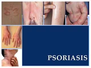 PSORIASIS
 