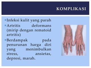 Infeksi kulit yang parah
Artritis deformans
(mirip dengan rematoid
artritis)
Berdampak pada
penurunan harga diri
yang menimbulkan
stress, ansietas,
depresi, marah.
KOMPLIKASI
 