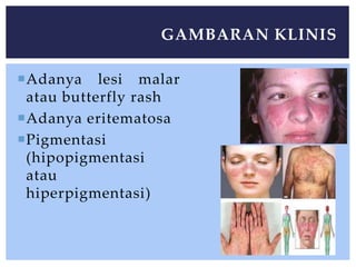 Adanya lesi malar
atau butterfly rash
Adanya eritematosa
Pigmentasi
(hipopigmentasi
atau
hiperpigmentasi)
GAMBARAN KLINIS
 