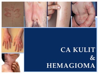 CA KULIT
&
HEMAGIOMA
 