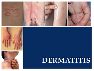 DERMATITIS
 