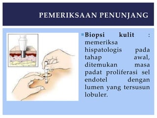 Biopsi kulit :
memeriksa
hispatologis pada
tahap awal,
ditemukan masa
padat proliferasi sel
endotel dengan
lumen yang tersusun
lobuler.
PEMERIKSAAN PENUNJANG
 