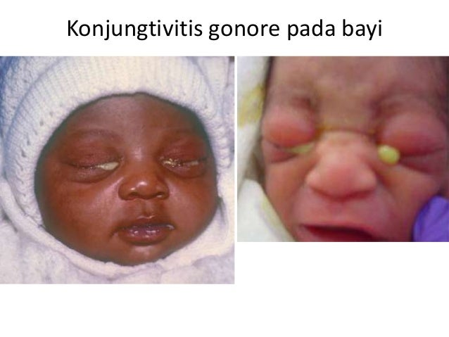 Askep konjungtivitis as
