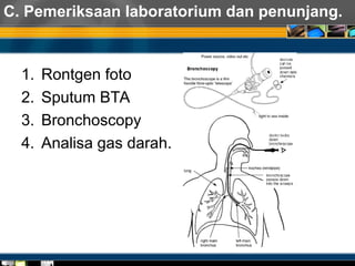 C. Pemeriksaan laboratorium dan penunjang.
1. Rontgen foto
2. Sputum BTA
3. Bronchoscopy
4. Analisa gas darah.
 