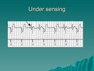 Under Sensing In Pacemaker SLIDE PPT ON TOPIC OF Temporary CARDIAC PACEMAKER | PPT