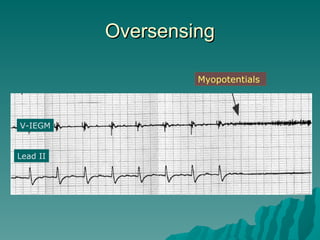 Myopotentials SLIDE PPT ON TOPIC OF Temporary CARDIAC PACEMAKER | PPT