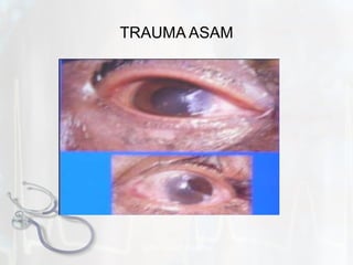 TRAUMA ASAM by.  N. Syamsi,  S.Kep.Ns 