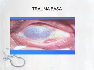 TRAUMA BASA b y  N. Syamsi,  S.Kep.Ns 
