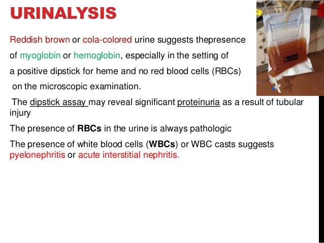 ACUTE KIDNEY INJURY AKI laboratory investigation