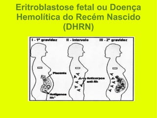 Eritroblastose fetal ou Doença
Hemolítica do Recém Nascido
(DHRN)
 