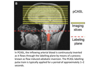 In PCASL, the inflowing arterial blood is continuously inverted
as it flows through the labelling plane by means of a process
known as flow induced adiabatic inversion. The PCASL labelling
pulse train is typically applied for a period of approximately 1–2
seconds.
 