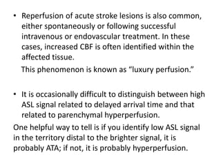 • Reperfusion of acute stroke lesions is also common,
either spontaneously or following successful
intravenous or endovascular treatment. In these
cases, increased CBF is often identified within the
affected tissue.
This phenomenon is known as “luxury perfusion.”
• It is occasionally difficult to distinguish between high
ASL signal related to delayed arrival time and that
related to parenchymal hyperperfusion.
One helpful way to tell is if you identify low ASL signal
in the territory distal to the brighter signal, it is
probably ATA; if not, it is probably hyperperfusion.
 