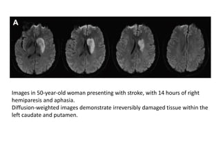 Images in 50-year-old woman presenting with stroke, with 14 hours of right
hemiparesis and aphasia.
Diffusion-weighted images demonstrate irreversibly damaged tissue within the
left caudate and putamen.
 