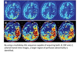 By using a multidelay ASL sequence capable of acquiring both, B, CBF and, C,
arterial transit time images, a larger region of perfusion abnormality is
identified.
 