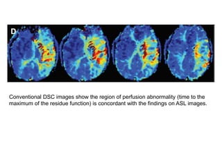 Conventional DSC images show the region of perfusion abnormality (time to the
maximum of the residue function) is concordant with the findings on ASL images.
 