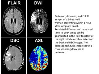 Perfusion, diffusion, and FLAIR
images of a 66-yearold
woman presenting within 1 hour
after symptom onset.
Restricted diffusion and increased
time-to-peak times can be
appreciated in the flow territory of
the right middle cerebral artery on
the DWI and DSC images. The
corresponding ASL image shows a
corresponding decrease in
perfusion.
 