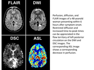 Perfusion, diffusion, and
FLAIR images of a 48-yearold
woman presenting within 6
hours after symptom onset.
Restricted diffusion and
increased time-to-peak times
can be appreciated in the
flow territory of left posterior
circulation on the DWI and
DSC images. The
corresponding ASL image
shows a corresponding
decrease in perfusion.
 