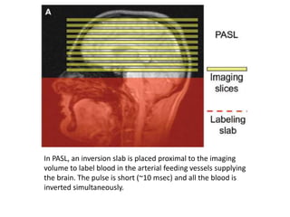 In PASL, an inversion slab is placed proximal to the imaging
volume to label blood in the arterial feeding vessels supplying
the brain. The pulse is short (~10 msec) and all the blood is
inverted simultaneously.
 