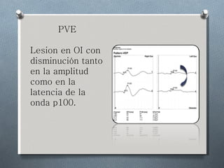 PVE Lesion en OI con disminución  tanto en la amplitud como en la latencia de la onda p100. 