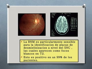 La RNM es particularmente sensible para la identificacion de placas de desmielinizacion a nivel del SNC , las cuales aparecen como focos blancos en T2.  Esto es positivo en un 99% de los pacientes.   