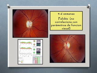 4-6 semanas Palidéz  (no correlaciona con parámetros de funcion visual) 