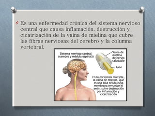 Es una enfermedad crónica del sistema nervioso central que causa inflamación, destrucción y cicatrización de la vaina de mielina que cubre las fibras nerviosas del cerebro y la columna vertebral.  
