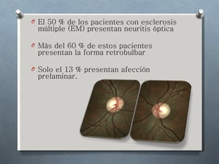 El 50 % de los pacientes con esclerosis múltiple (EM) presentan neuritis óptica Más del 60 % de estos pacientes presentan la forma retrobulbar Solo el 13 % presentan afección prelaminar.  