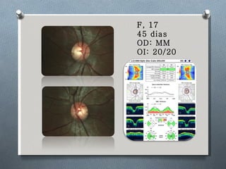 F, 17 45 dias OD: MM OI: 20/20 