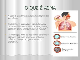 O QUE É ASMA A asma é uma doença inflamatória crônica das vias aéreas.  Em indivíduos susceptíveis esta inflamação causa episódios recorrentes de tosse, chiado, aperto no peito, e dificuldade para respirar.  “ A inflamação torna as vias aéreas sensíveis a estímulos tais como alérgenos, irritantes químicos, fumaça de cigarro, ar frio ou exercícios”. 