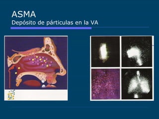 ASMA Depósito de párticulas en la VA 