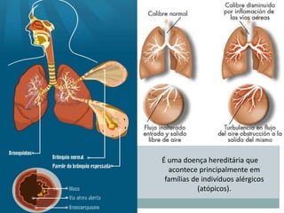 É uma doença hereditária que
acontece principalmente em
famílias de indivíduos alérgicos
(atópicos).
 