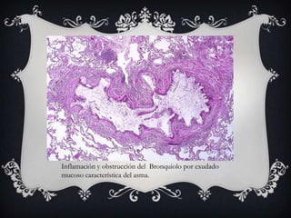 Inflamación y obstrucción del Bronquiolo por exudado
mucoso característica del asma.
 