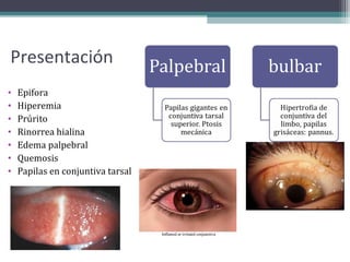 Presentación
•   Epifora
•   Hiperemia
•   Prúrito
•   Rinorrea hialina
•   Edema palpebral
•   Quemosis
•   Papilas en conjuntiva tarsal
 