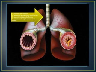 Generación, amplificación
 1.y perpetuación del
    Aumento de colágeno
  proceso inflamatorio
 2. Hipertrofia e hiperplasia musculo liso
  3. Aumento células caliciformes
  4. remodelación tejido conectivo vía
  aérea
 