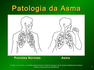 77
Patologia da AsmaPatologia da Asma
Pulmões NormaisPulmões Normais AsmaAsma
Fuente: “Lo que Ud. y su familia pueden hacer en relación al asma” de la Iniciativa Global para el AsmaFuente: “Lo que Ud. y su familia pueden hacer en relación al asma” de la Iniciativa Global para el Asma
Creado y financiado por NIH/NHLBICreado y financiado por NIH/NHLBI
 